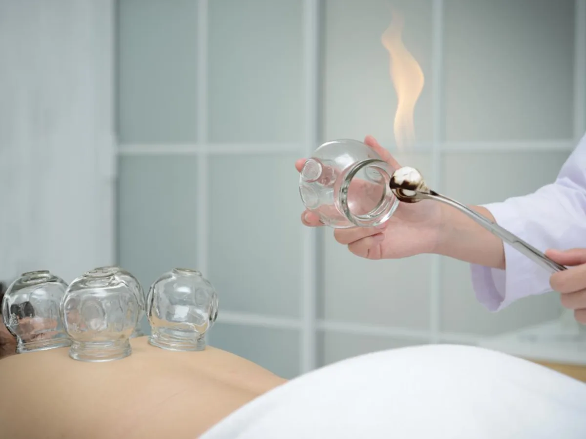 Pose de ventouses en verre chauffées sur le dos d'une patiente pendant une séance